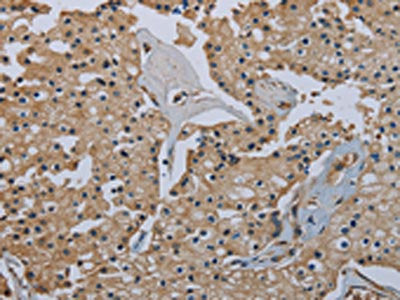 The image on the left is immunohistochemistry of paraffin-embedded Human prostate cancer tissue using CSB-PA549292(FLCN Antibody) at dilution 1/40, on the right is treated with fusion protein. (Original magnification: ×200)