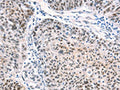 The image on the left is immunohistochemistry of paraffin-embedded Human ovarian cancer tissue using CSB-PA549967(CTBP2 Antibody) at dilution 1/40, on the right is treated with synthetic peptide. (Original magnification: ×200)