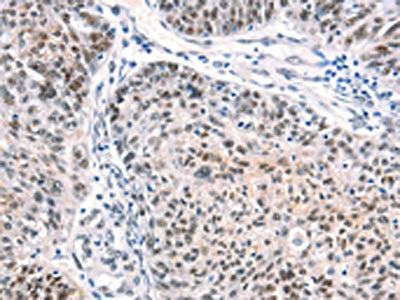 The image on the left is immunohistochemistry of paraffin-embedded Human ovarian cancer tissue using CSB-PA549967(CTBP2 Antibody) at dilution 1/40, on the right is treated with synthetic peptide. (Original magnification: ×200)