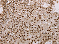 The image on the left is immunohistochemistry of paraffin-embedded Human breast cancer tissue using CSB-PA550074(AKAP8L Antibody) at dilution 1/15, on the right is treated with fusion protein. (Original magnification: ×200)