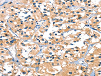 The image on the left is immunohistochemistry of paraffin-embedded Human thyroid cancer tissue using CSB-PA550133(SLC6A4 Antibody) at dilution 1/30, on the right is treated with synthetic peptide. (Original magnification: ×200)
