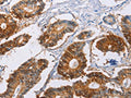 The image on the left is immunohistochemistry of paraffin-embedded Human colon cancer tissue using CSB-PA550152(CA9 Antibody) at dilution 1/40, on the right is treated with fusion protein. (Original magnification: ×200)