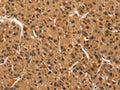 The image on the left is immunohistochemistry of paraffin-embedded Human liver cancer tissue using CSB-PA550437(CCNT1 Antibody) at dilution 1/30, on the right is treated with synthetic peptide. (Original magnification: ×200)