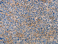 The image on the left is immunohistochemistry of paraffin-embedded Human liver cancer tissue using CSB-PA550481(ALOX15B Antibody) at dilution 1/15, on the right is treated with fusion protein. (Original magnification: ×200)