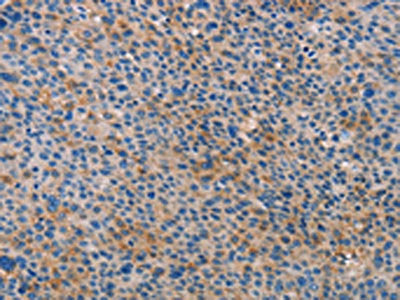 The image on the left is immunohistochemistry of paraffin-embedded Human liver cancer tissue using CSB-PA550481(ALOX15B Antibody) at dilution 1/15, on the right is treated with fusion protein. (Original magnification: ×200)