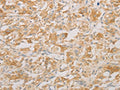 The image on the left is immunohistochemistry of paraffin-embedded Human thyroid cancer tissue using CSB-PA551903(AES Antibody) at dilution 1/20, on the right is treated with fusion protein. (Original magnification: ×200)