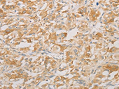 The image on the left is immunohistochemistry of paraffin-embedded Human thyroid cancer tissue using CSB-PA551903(AES Antibody) at dilution 1/20, on the right is treated with fusion protein. (Original magnification: ×200)