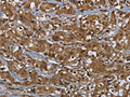 The image on the left is immunohistochemistry of paraffin-embedded Human breast cancer tissue using CSB-PA552215(GCK Antibody) at dilution 1/60, on the right is treated with fusion protein. (Original magnification: ×200)