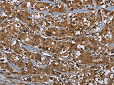 The image on the left is immunohistochemistry of paraffin-embedded Human breast cancer tissue using CSB-PA552215(GCK Antibody) at dilution 1/60, on the right is treated with fusion protein. (Original magnification: ×200)