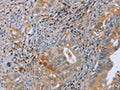 The image on the left is immunohistochemistry of paraffin-embedded Human cervical cancer tissue using CSB-PA552403(GMFG Antibody) at dilution 1/50, on the right is treated with fusion protein. (Original magnification: ×200)