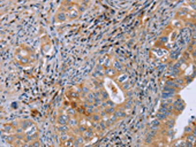 The image on the left is immunohistochemistry of paraffin-embedded Human cervical cancer tissue using CSB-PA552403(GMFG Antibody) at dilution 1/50, on the right is treated with fusion protein. (Original magnification: ×200)