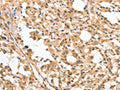 The image on the left is immunohistochemistry of paraffin-embedded Human thyroid cancer tissue using CSB-PA552720(APTX Antibody) at dilution 1/50, on the right is treated with fusion protein. (Original magnification: ×200)