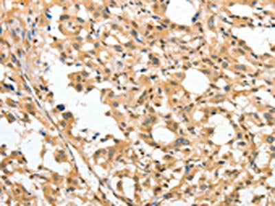 The image on the left is immunohistochemistry of paraffin-embedded Human thyroid cancer tissue using CSB-PA552720(APTX Antibody) at dilution 1/50, on the right is treated with fusion protein. (Original magnification: ×200)