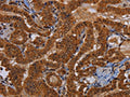 The image on the left is immunohistochemistry of paraffin-embedded Human thyroid cancer tissue using CSB-PA552938(WDR83 Antibody) at dilution 1/60, on the right is treated with fusion protein. (Original magnification: ×200)