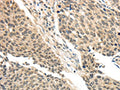 The image on the left is immunohistochemistry of paraffin-embedded Human lung cancer tissue using CSB-PA553405(BRCA2 Antibody) at dilution 1/35, on the right is treated with synthetic peptide. (Original magnification: ×200)
