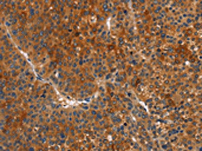 The image on the left is immunohistochemistry of paraffin-embedded Human liver cancer tissue using CSB-PA553472(MAPK15 Antibody) at dilution 1/15, on the right is treated with fusion protein. (Original magnification: ×200)