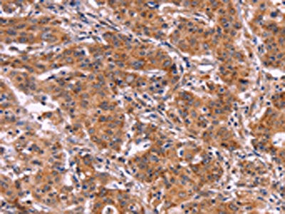 The image on the left is immunohistochemistry of paraffin-embedded Human gastic cancer tissue using CSB-PA553918(MMP14 Antibody) at dilution 1/40, on the right is treated with fusion protein. (Original magnification: ×200)