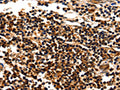 The image on the left is immunohistochemistry of paraffin-embedded Human liver cancer tissue using CSB-PA554071(MYOZ1 Antibody) at dilution 1/25, on the right is treated with fusion protein. (Original magnification: ×200)