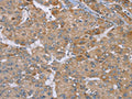 The image on the left is immunohistochemistry of paraffin-embedded Human liver cancer tissue using CSB-PA554695(ACTN2 Antibody) at dilution 1/30, on the right is treated with synthetic peptide. (Original magnification: x200)