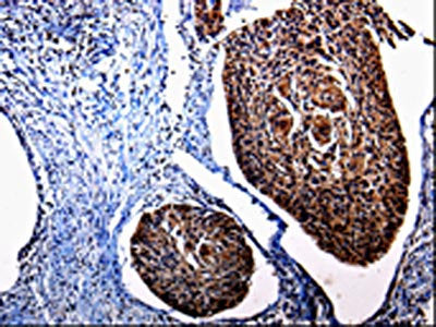 The image is immunohistochemistry of paraffin-embedded Human cervical cancer tissue using CSB-PA554992(KLK3 Antibody) at dilution 1/25. (Original magnification: ×200)