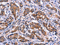 The image on the left is immunohistochemistry of paraffin-embedded Human breast cancer tissue using CSB-PA555295(EIF2AK4 Antibody) at dilution 1/50, on the right is treated with fusion protein. (Original magnification: ×200)