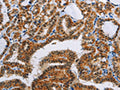 The image on the left is immunohistochemistry of paraffin-embedded Human thyroid cancer tissue using CSB-PA555438(ACVR1B Antibody) at dilution 1/55, on the right is treated with fusion protein. (Original magnification: ×200)