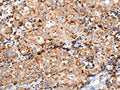 The image on the left is immunohistochemistry of paraffin-embedded Human breast cancer tissue using CSB-PA555678(MUC1(CT) Antibody) at dilution 1/20, on the right is treated with synthetic peptide. (Original magnification: ×200)