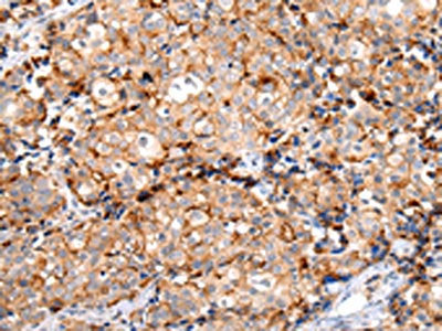 The image on the left is immunohistochemistry of paraffin-embedded Human breast cancer tissue using CSB-PA555678(MUC1(CT) Antibody) at dilution 1/20, on the right is treated with synthetic peptide. (Original magnification: ×200)