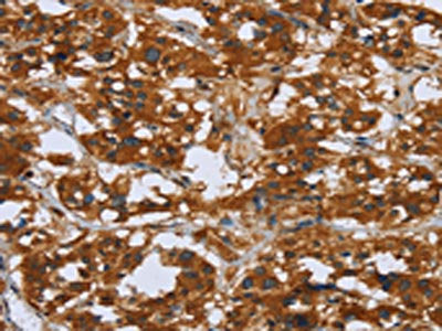 The image on the left is immunohistochemistry of paraffin-embedded Human thyroid cancer tissue using CSB-PA556201(COMP Antibody) at dilution 1/50, on the right is treated with fusion protein. (Original magnification: ×200)