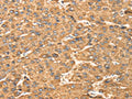 The image on the left is immunohistochemistry of paraffin-embedded Human liver cancer tissue using CSB-PA556658(MAPK7 Antibody) at dilution 1/20, on the right is treated with fusion protein. (Original magnification: ×200)