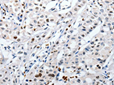 The image on the left is immunohistochemistry of paraffin-embedded Human lung cancer tissue using CSB-PA556911(HSPA1A Antibody) at dilution 1/60, on the right is treated with fusion protein. (Original magnification: ×200)