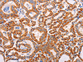 The image on the left is immunohistochemistry of paraffin-embedded Human thyroid cancer tissue using CSB-PA557372(ADAMTS17 Antibody) at dilution 1/60, on the right is treated with synthetic peptide. (Original magnification: ×200)