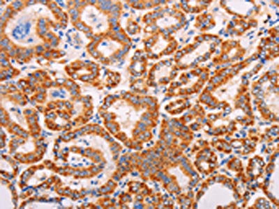 The image on the left is immunohistochemistry of paraffin-embedded Human thyroid cancer tissue using CSB-PA557372(ADAMTS17 Antibody) at dilution 1/60, on the right is treated with synthetic peptide. (Original magnification: ×200)