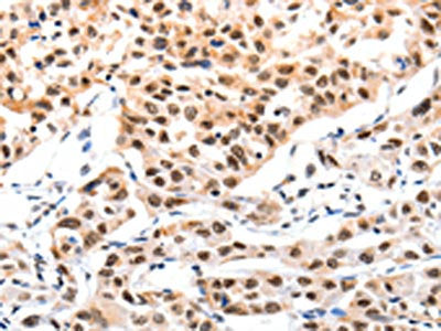 The image on the left is immunohistochemistry of paraffin-embedded Human lung cancer tissue using CSB-PA557525(CBX8 Antibody) at dilution 1/10, on the right is treated with fusion protein. (Original magnification: ×200)