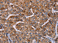 The image on the left is immunohistochemistry of paraffin-embedded Human liver cancer tissue using CSB-PA557724(HSPE1 Antibody) at dilution 1/40, on the right is treated with synthetic peptide. (Original magnification: ×200)