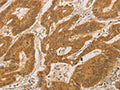 The image on the left is immunohistochemistry of paraffin-embedded Human colon cancer tissue using CSB-PA558008(PSMB7 Antibody) at dilution 1/25, on the right is treated with fusion protein. (Original magnification: ×200)