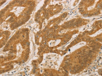 The image on the left is immunohistochemistry of paraffin-embedded Human colon cancer tissue using CSB-PA558008(PSMB7 Antibody) at dilution 1/25, on the right is treated with fusion protein. (Original magnification: ×200)