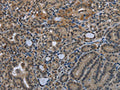 The image on the left is immunohistochemistry of paraffin-embedded Human thyroid cancer tissue using CSB-PA558316(GDF3 Antibody) at dilution 1/25, on the right is treated with fusion protein. (Original magnification: ×200)