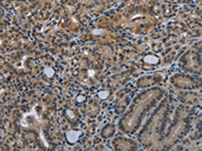 The image on the left is immunohistochemistry of paraffin-embedded Human thyroid cancer tissue using CSB-PA558316(GDF3 Antibody) at dilution 1/25, on the right is treated with fusion protein. (Original magnification: ×200)