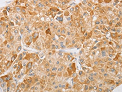 The image on the left is immunohistochemistry of paraffin-embedded Human liver cancer tissue using CSB-PA558560(NGF Antibody) at dilution 1/40, on the right is treated with fusion protein. (Original magnification: ×200)