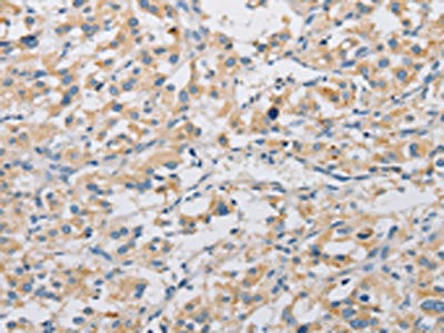 The image on the left is immunohistochemistry of paraffin-embedded Human thyroid cancer tissue using CSB-PA558670(KAT5 Antibody) at dilution 1/20, on the right is treated with fusion protein. (Original magnification: ×200)