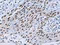 The image on the left is immunohistochemistry of paraffin-embedded Human esophagus cancer tissue using CSB-PA559356(CAPN6 Antibody) at dilution 1/15, on the right is treated with fusion protein. (Original magnification: ×200)