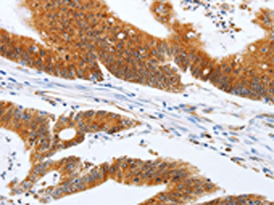 The image on the left is immunohistochemistry of paraffin-embedded Human colon cancer tissue using CSB-PA559431(SPATA13 Antibody) at dilution 1/20, on the right is treated with fusion protein. (Original magnification: ×200)