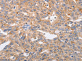 The image on the left is immunohistochemistry of paraffin-embedded Human ovarian cancer tissue using CSB-PA559752(PPP1CB Antibody) at dilution 1/40, on the right is treated with fusion protein. (Original magnification: ×200)