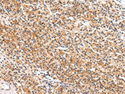 The image on the left is immunohistochemistry of paraffin-embedded Human prostate cancer tissue using CSB-PA560086(APLN Antibody) at dilution 1/20, on the right is treated with synthetic peptide. (Original magnification: ×200)