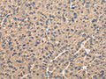 The image on the left is immunohistochemistry of paraffin-embedded Human liver cancer tissue using CSB-PA560189(UQCRC1 Antibody) at dilution 1/35, on the right is treated with fusion protein. (Original magnification: ×200)