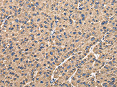 The image on the left is immunohistochemistry of paraffin-embedded Human liver cancer tissue using CSB-PA560189(UQCRC1 Antibody) at dilution 1/35, on the right is treated with fusion protein. (Original magnification: ×200)