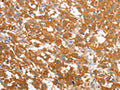 The image on the left is immunohistochemistry of paraffin-embedded Human thyroid cancer tissue using CSB-PA560286(WNT3A Antibody) at dilution 1/40, on the right is treated with fusion protein. (Original magnification: ×200)