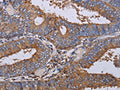 The image on the left is immunohistochemistry of paraffin-embedded Human colon cancer tissue using CSB-PA560467(LIMS1 Antibody) at dilution 1/40, on the right is treated with fusion protein. (Original magnification: ×200)