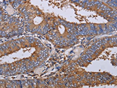 The image on the left is immunohistochemistry of paraffin-embedded Human colon cancer tissue using CSB-PA560467(LIMS1 Antibody) at dilution 1/40, on the right is treated with fusion protein. (Original magnification: ×200)